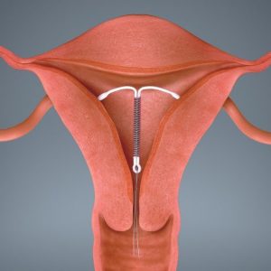 Review Pengalaman Pasang IUD atau KB Spiral di Puskesmas, Gratis