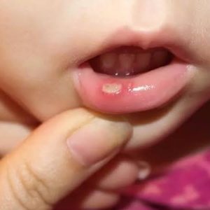Ini Penyebab Sering Alami Sariawan dan Cara Penyembuhannya dengan Cepat