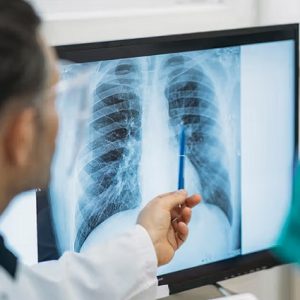 Dinkes Bandar Lampung Gunakan X-ray Portabel untuk Percepat Deteksi TBC